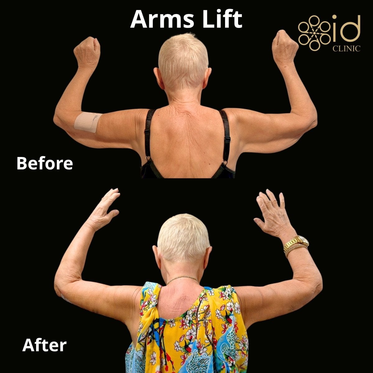 Resultados de lifting de brazos antes y después en ID Clinic Bangkok, mejor contorno y piel
