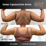 Результаты Vaser липосакции рук до и после в ID Clinic Bangkok, более стройные руки