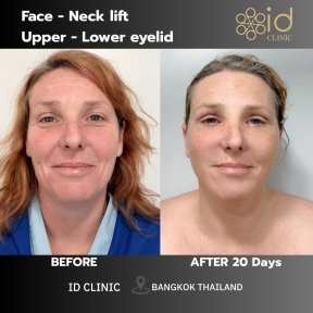 Результаты до и после подтяжки лица, шеи и век в ID Clinic Bangkok