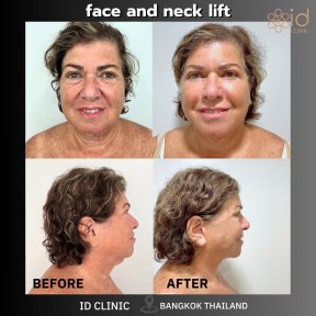 Результаты до и после подтяжки лица и шеи в ID Clinic Bangkok, видимое омоложение