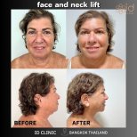 Результаты до и после подтяжки лица и шеи в ID Clinic Bangkok, видимое омоложение