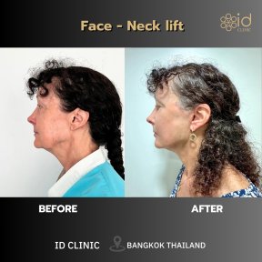 Результаты до и после фейслифтинга и подтяжки шеи в ID Clinic Bangkok, омоложение