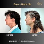Результаты до и после фейслифтинга и подтяжки шеи в ID Clinic Bangkok, омоложение