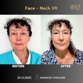 Результаты до и после фейслифтинга и подтяжки шеи в ID Clinic Bangkok, омоложение лица