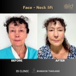 Результаты до и после фейслифтинга и подтяжки шеи в ID Clinic Bangkok, омоложение лица