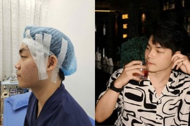 Результати ринопластики до і після в Doctor International Aesthetics, покращений профіль носа