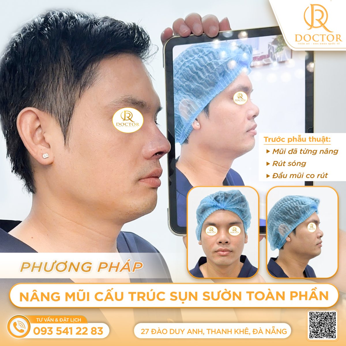 Resultados de rinoplastia antes y después en Doctor International Aesthetics, perfil nasal mejorado