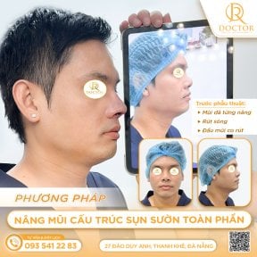 Результати ринопластики до і після в Doctor International Aesthetics, покращений профіль носа