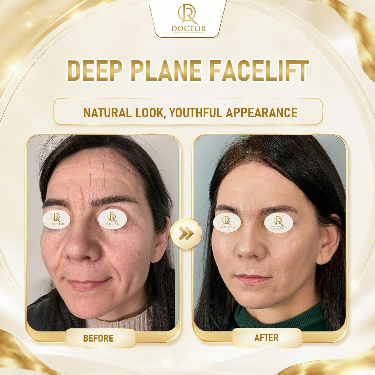 نتائج شد الوجه العميق قبل وبعد في Doctor International Aesthetics، مظهر شبابي