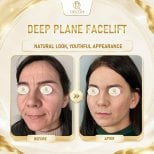 Before and after deep plane facelift results at Doctor International Aesthetics, youthful look