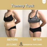 Результаты до и после абдоминопластики в ID Clinic Bangkok – улучшение контура живота