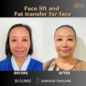 نتائج شد الوجه ونقل الدهون للوجه قبل وبعد في ID Clinic Bangkok، تجديد الشباب