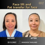 نتائج شد الوجه ونقل الدهون للوجه قبل وبعد في ID Clinic Bangkok، تجديد الشباب