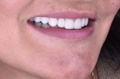 Dental implant result at Dentaland Premium Luxury Clinic & Academy – restored natural smile