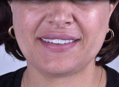 Dental implant result at Dentaland Premium Luxury Clinic & Academy, restored natural smile