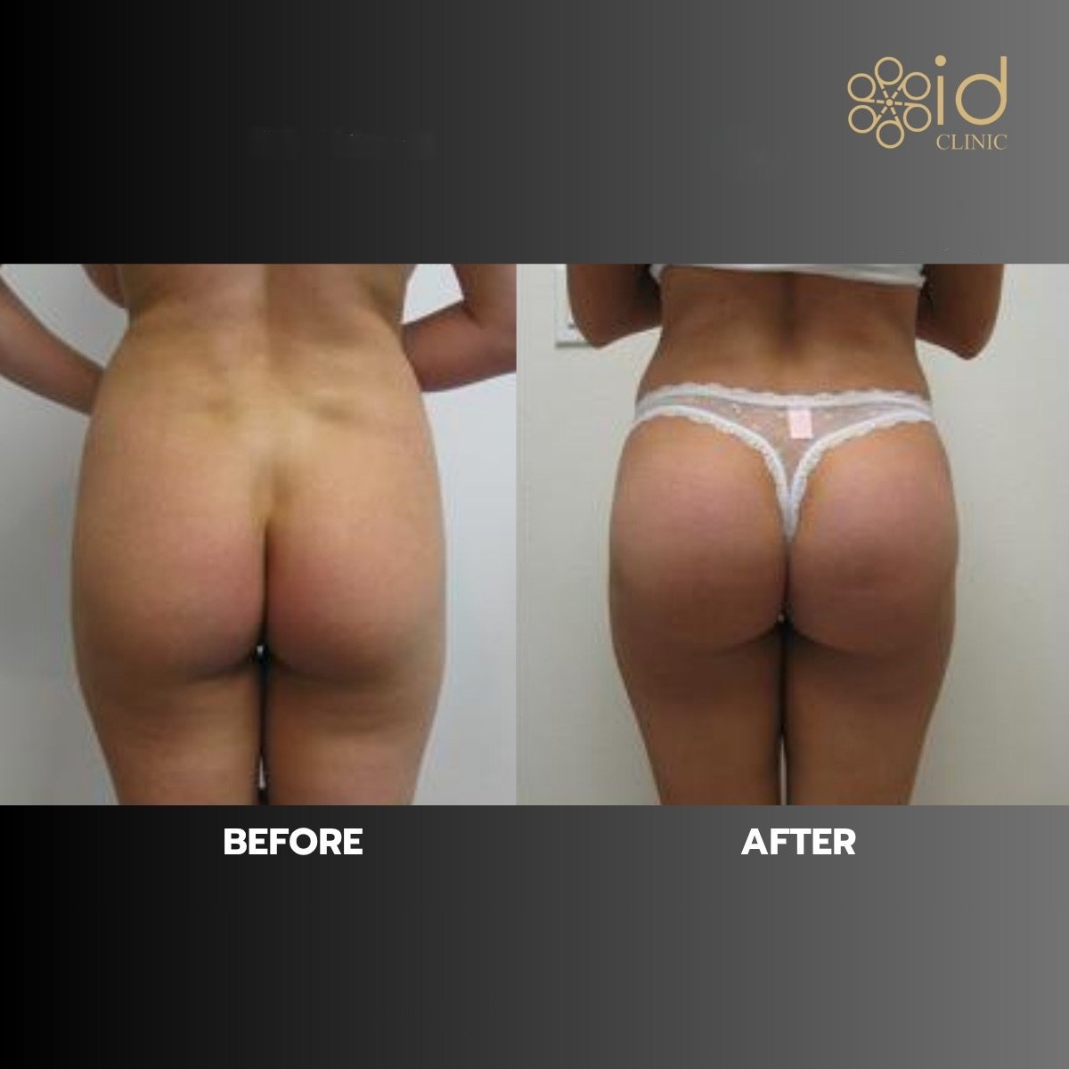 قبل وبعد زرع المؤخرة في ID Clinic Bangkok، نتيجة تحسين شكل الأرداف