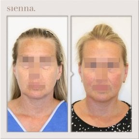 before-after photo tightening-of-facial-skin-facelift