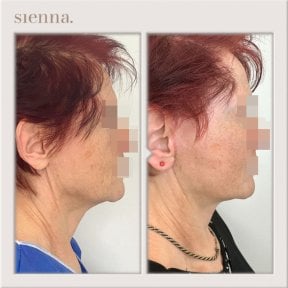 before-after photo tightening-of-facial-skin-facelift