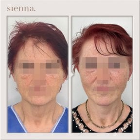 before-after photo tightening-of-facial-skin-facelift