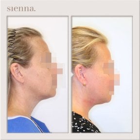 before-after photo tightening-of-facial-skin-facelift