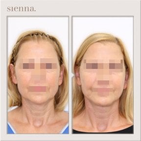 before-after photo tightening-of-facial-skin-facelift