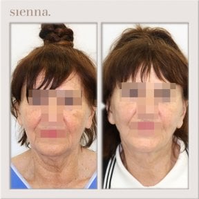 before-after photo tightening-of-facial-skin-facelift