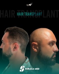 before-after photo fue-hair-transplant