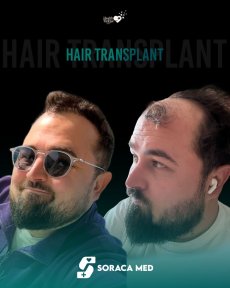 before-after photo fue-hair-transplant