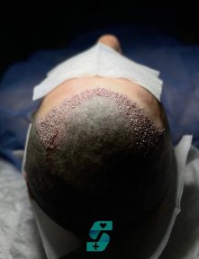 before-after photo fue-hair-transplant
