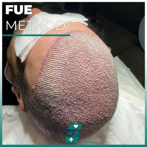 before-after photo fue-hair-transplant