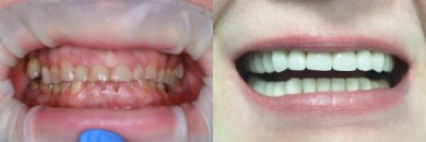 before-after photo installation-of-a-veneer