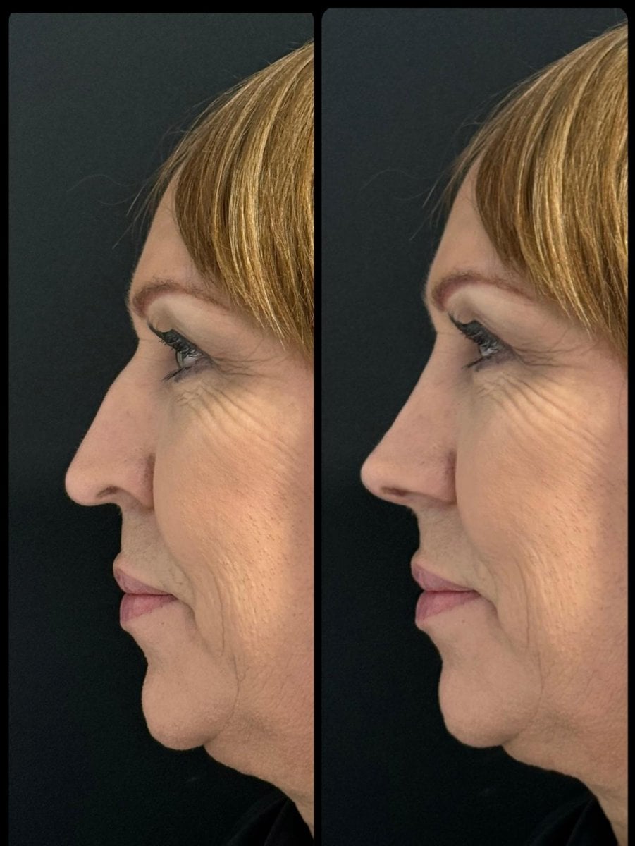 before-after photo