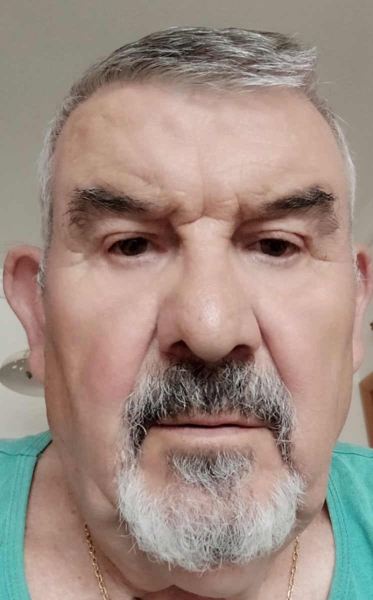 before-after photo