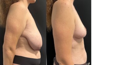 Результати до і після підтяжки грудей у Gender Medic Unit – кращий контур і пружність