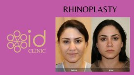 Efekty przed i po etnicznej plastyce nosa w ID Clinic Bangkok, korekta kształtu nosa