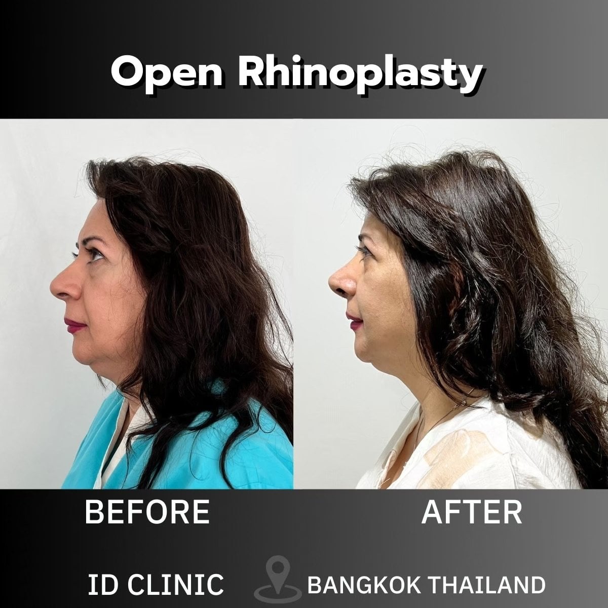 Resultados antes y después de rinoplastia abierta en ID Clinic Bangkok, cambio visible de nariz