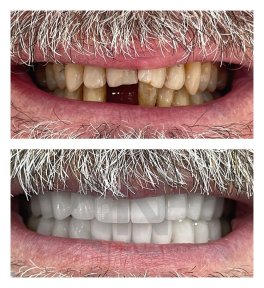 before-after photo same-day-all-on-6-dental-implants