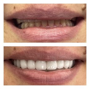 before-after photo same-day-all-on-6-dental-implants