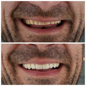 before-after photo same-day-all-on-6-dental-implants