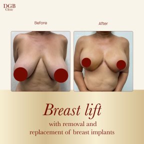 before-after photo liposuction