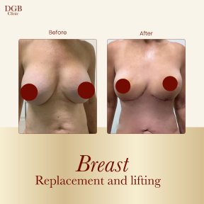 before-after photo liposuction