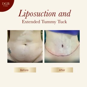 before-after photo liposuction