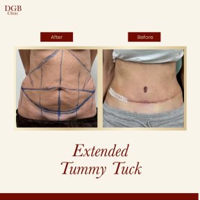 before-after photo liposuction