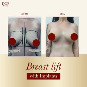 before-after photo liposuction