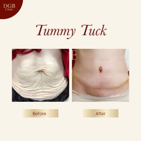 before-after photo liposuction