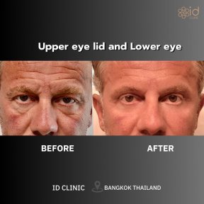 before-after photo blepharoplasty-eyelid