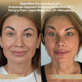 before-after photo facial-fat-transfer
