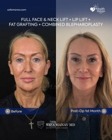 before-after photo facial-fat-transfer