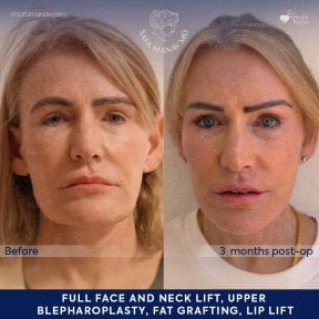 before-after photo facial-fat-transfer