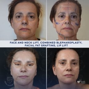 before-after photo facial-fat-transfer